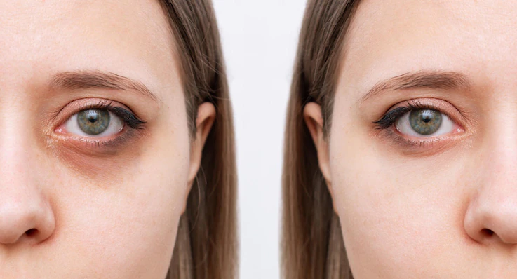 Dark circle under eye