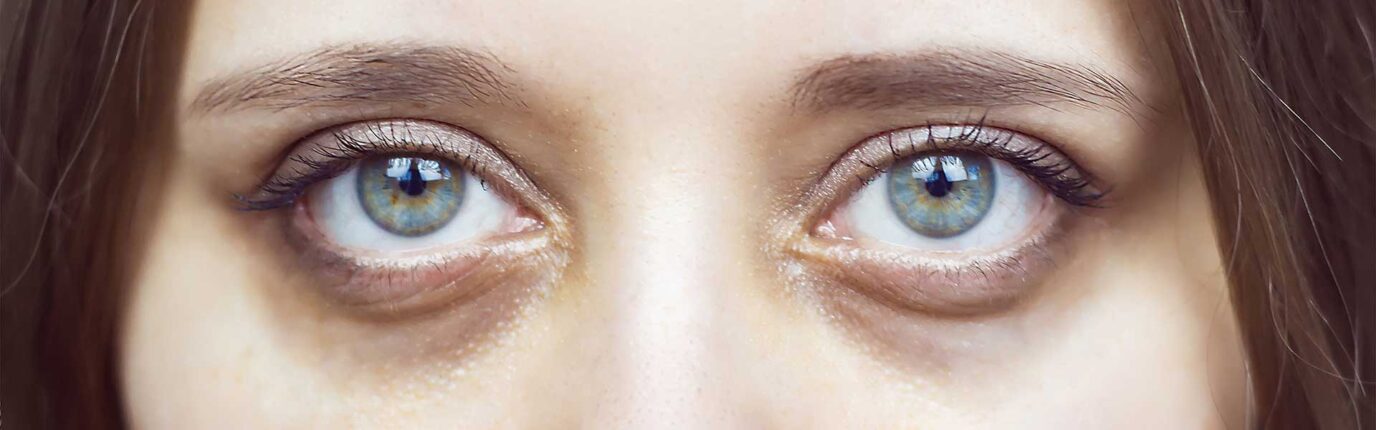 Dark circles under eyes