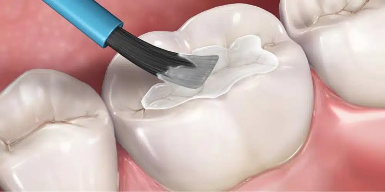Dental sealants