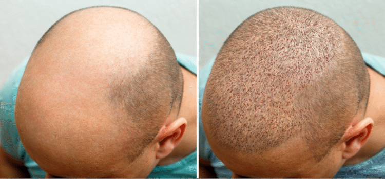 Hair transplant surgery