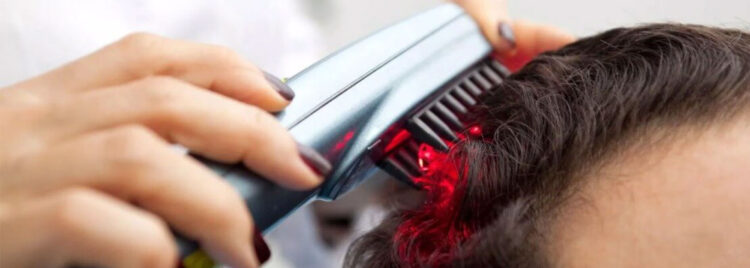 Low level laser therapy for hair loss